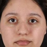 Cosmetic Injectables Before & After Patient #2253