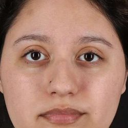 Cosmetic Injectables Before & After Patient #2253