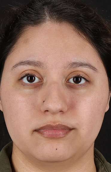 Cosmetic Injectables Before & After Patient #2253