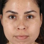 Cosmetic Injectables Before & After Patient #2264