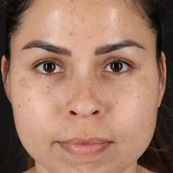 Cosmetic Injectables Before & After Patient #2264