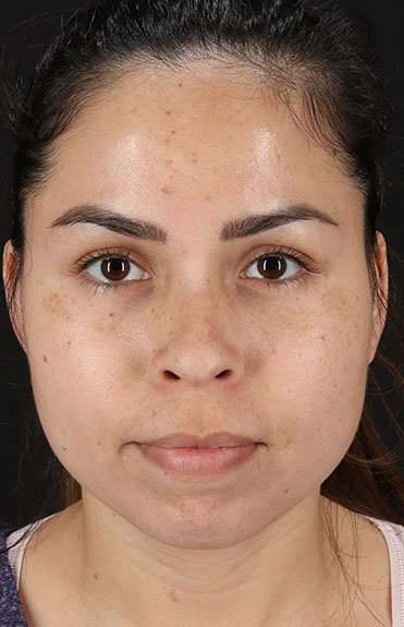 Cosmetic Injectables Before & After Patient #2264