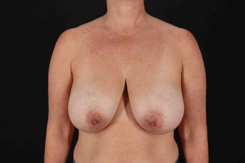 Breast Reduction with Lift Before & After Patient #939
