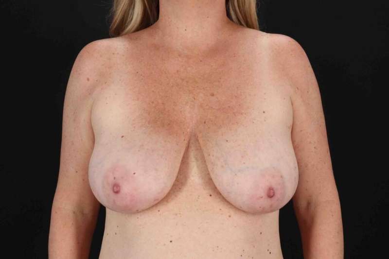 Breast Reduction with Lift Before & After Patient #983