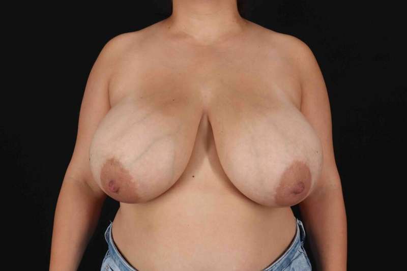 Breast Reduction with Lift Before & After Patient #994
