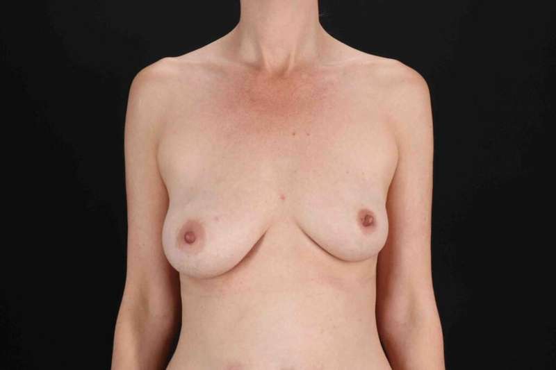 Breast Augmentation with Fat Transfer Before & After Patient #806