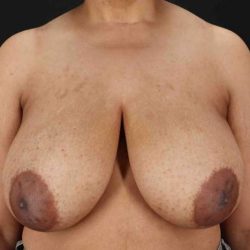 Breast Reduction with Lift Before & After Patient #1005