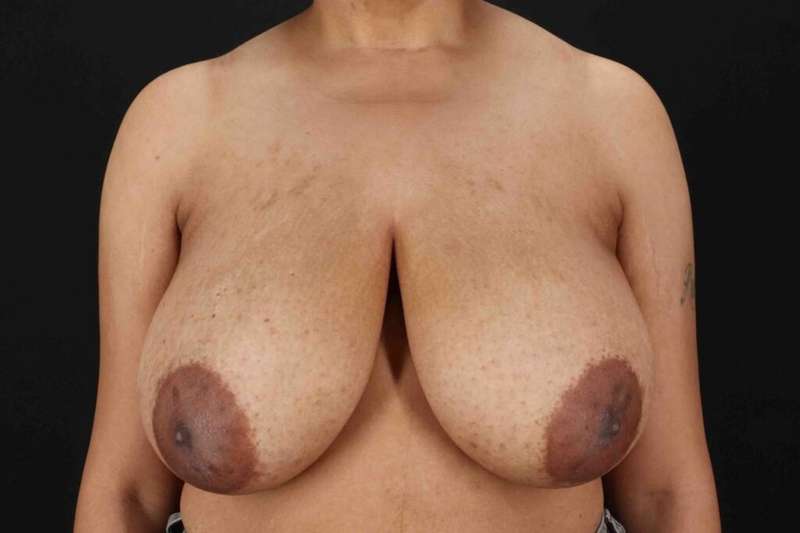 Breast Reduction with Lift Before & After Patient #1005