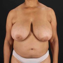 Breast Reconstruction Before & After Patient #1038