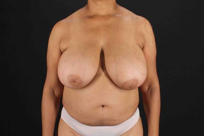 Breast Reconstruction Before & After Patient #1038