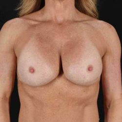 Breast Lift Before & After Patient #1060