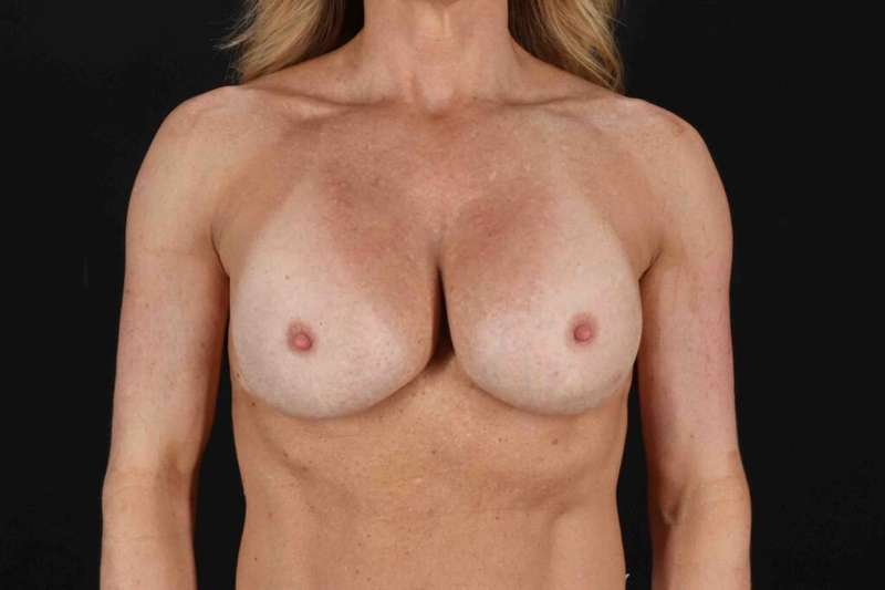 Breast Lift Before & After Patient #1060