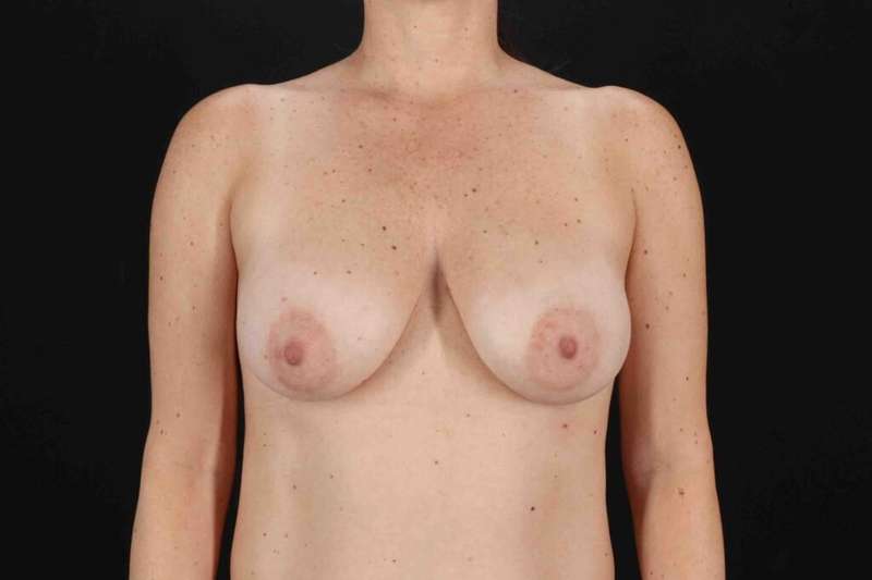 Breast Lift Before & After Patient #1071
