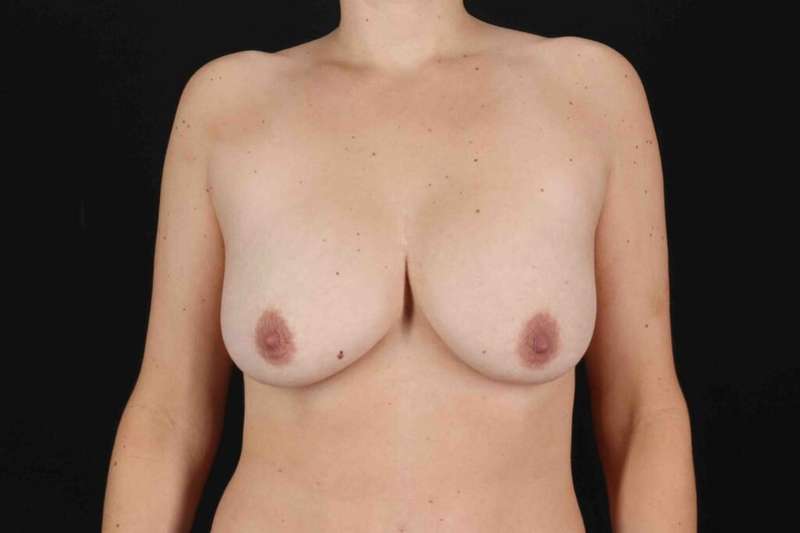 Breast Lift Before & After Patient #1104