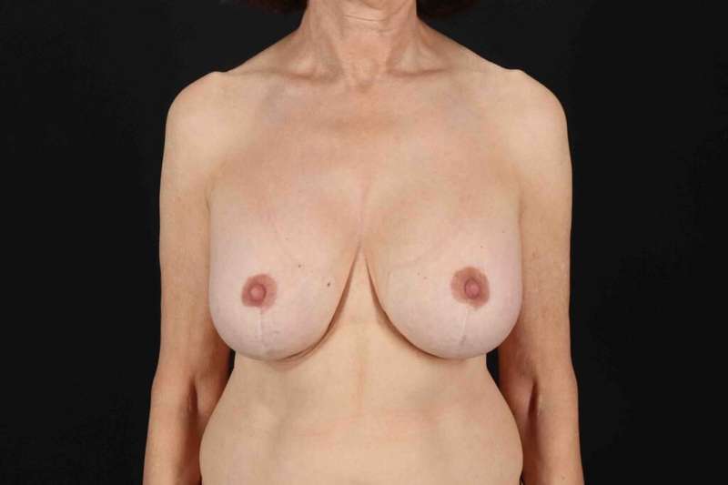 Breast Augmentation with Fat Transfer Before & After Patient #817