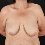 Breast Lift Before & After Patient #1192