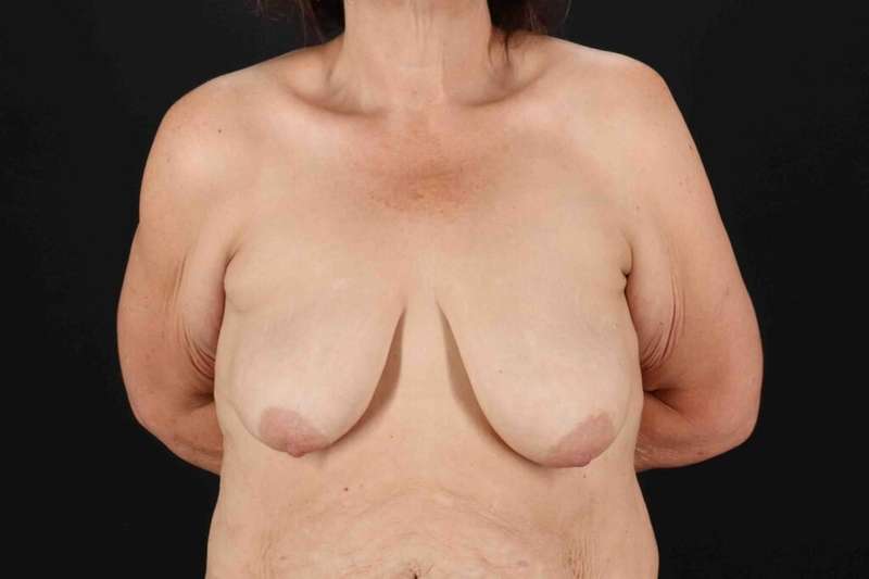 Breast Lift Before & After Patient #1192