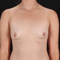 Breast Augmentation with Implants Before & After Patient #1203