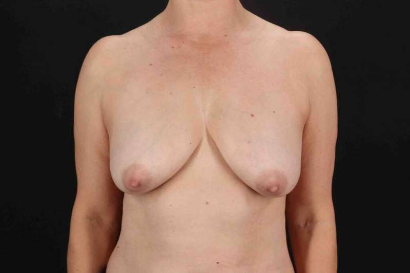 Breast Augmentation with Implants Before & After Patient #1225