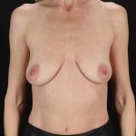 Breast Augmentation with Implants Before & After Patient #1236