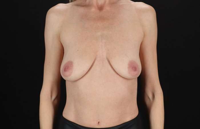 Breast Augmentation with Implants Before & After Patient #1236