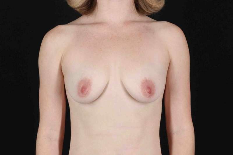 Breast Augmentation with Implants Before & After Patient #1247