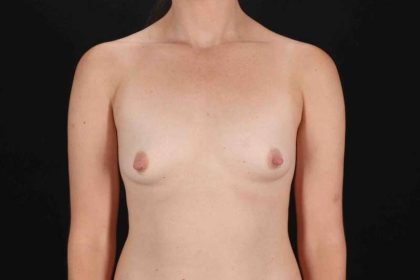 Breast Augmentation with Fat Transfer Before & After Patient #784