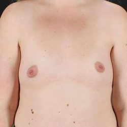 Breast Augmentation with Implants Before & After Patient #1258