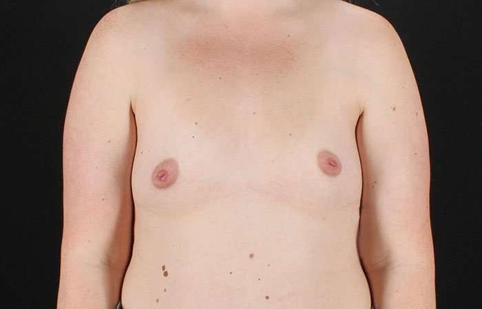 Breast Augmentation with Implants Before & After Patient #1258