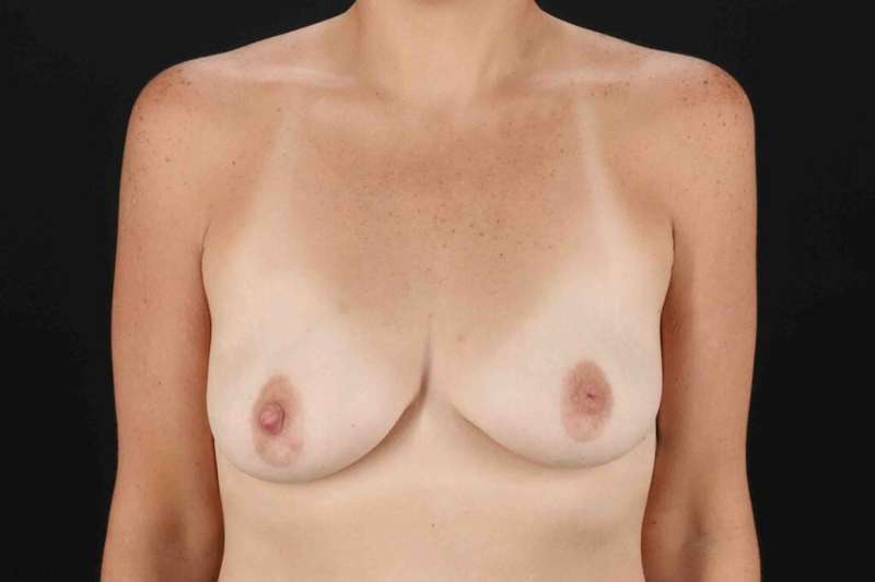 Breast Augmentation with Implants Before & After Patient #1269