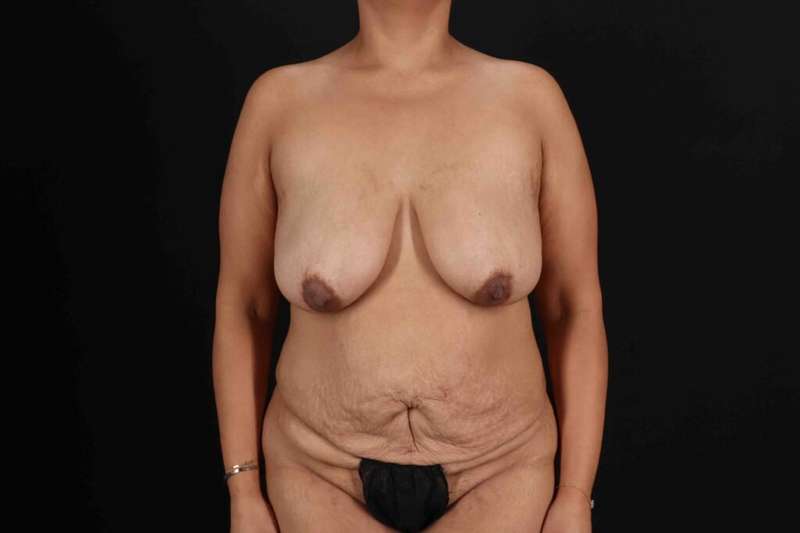 Mommy Makeover Before & After Patient #1299
