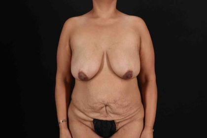 Liposuction Before & After Patient #1390
