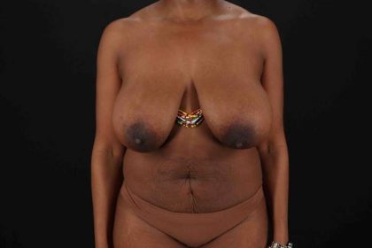 Tummy Tuck Before & After Patient #1451