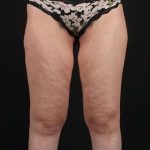 Thigh Lift Before & After Patient #1533