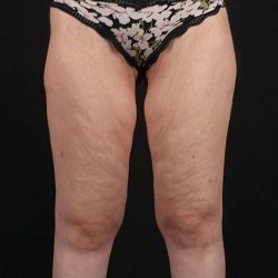 Thigh Lift Before & After Patient #1533