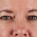 Brow Lift Before & After Patient #1566
