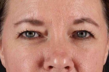 Brow Lift Before & After Patient #1566