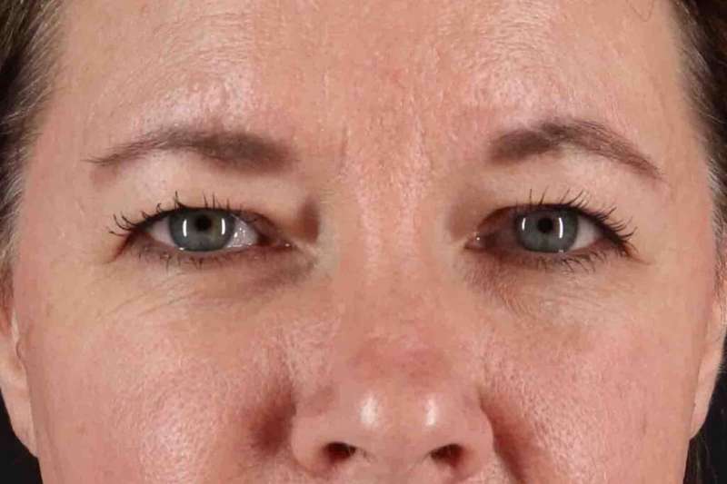 Brow Lift Before & After Patient #1566