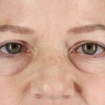 Brow Lift Before & After Patient #1577