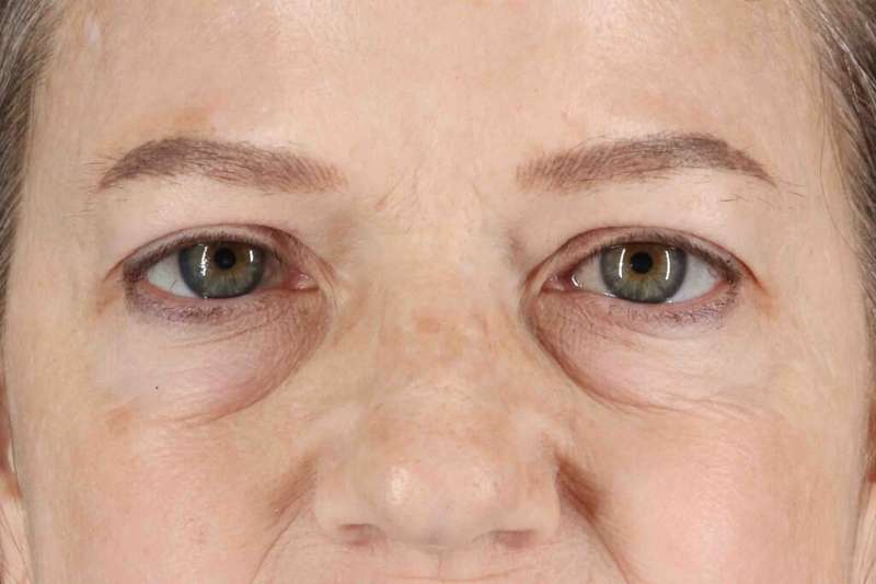 Brow Lift Before & After Patient #1577