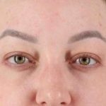 Brow Lift Before & After Patient #1588