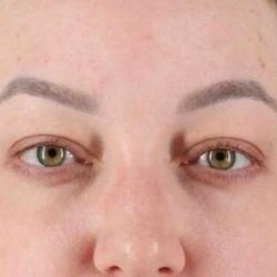Brow Lift Before & After Patient #1588