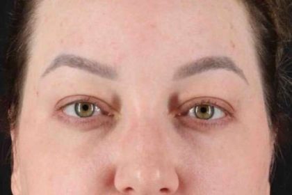 Brow Lift Before & After Patient #1588