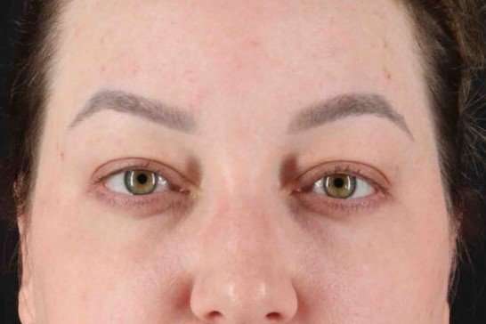 Brow Lift Before & After Patient #1588