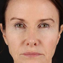 Face Lift Before & After Patient #1632