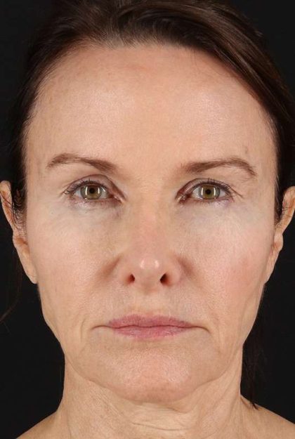 Face Lift Before & After Patient #1632