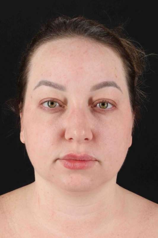 Face Lift Before & After Patient #1654