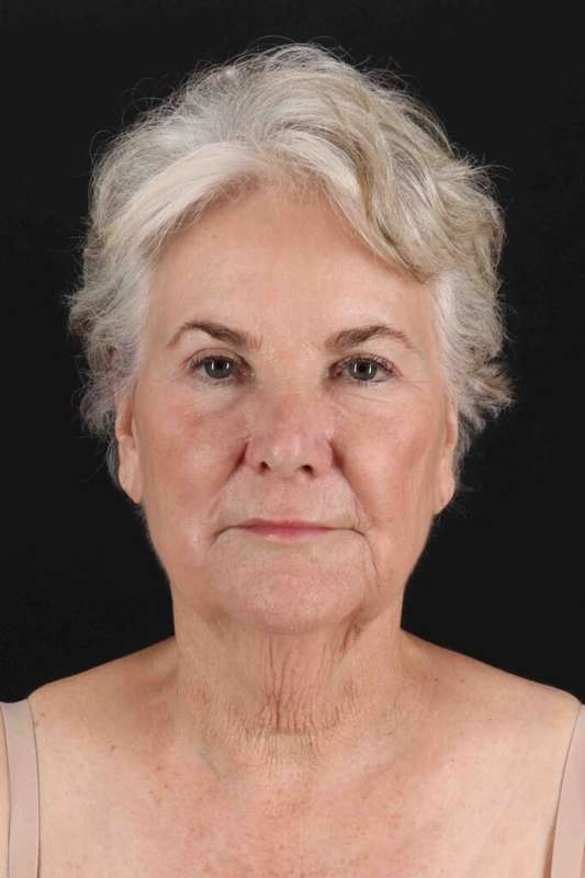 Neck Lift Before & After Patient #1676