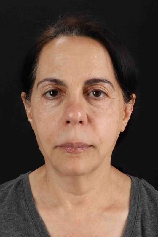 Neck Lift Before & After Patient #1687