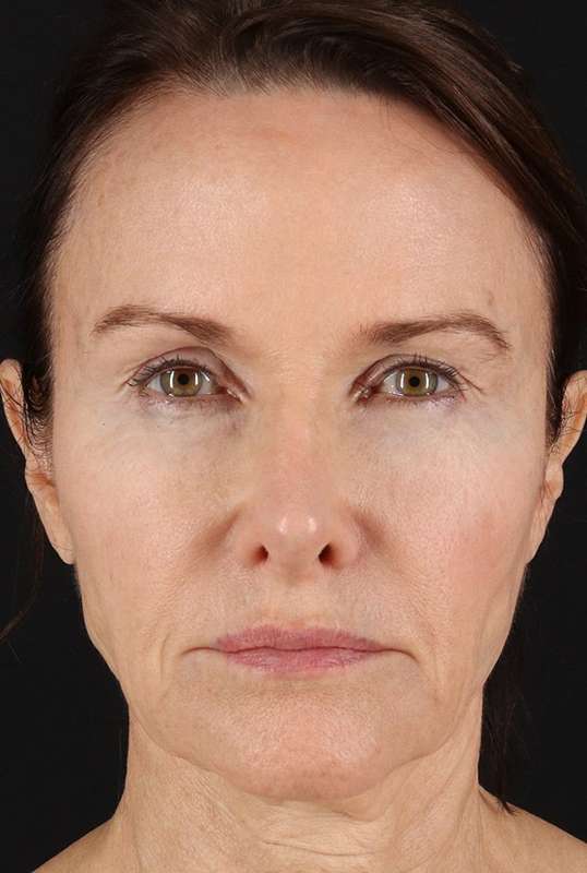 Neck Lift Before & After Patient #1698